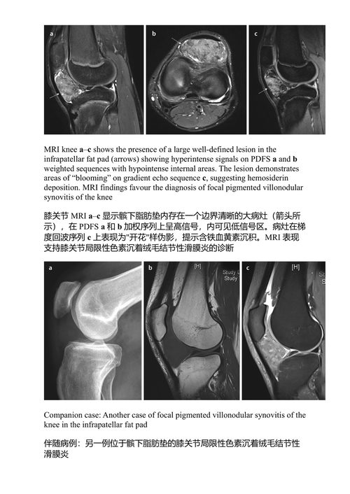 101膝关节影像病例集 索纳尔·萨兰、阿米特·卡拉特、拉杰什·博特丘 (中英对照电子书)