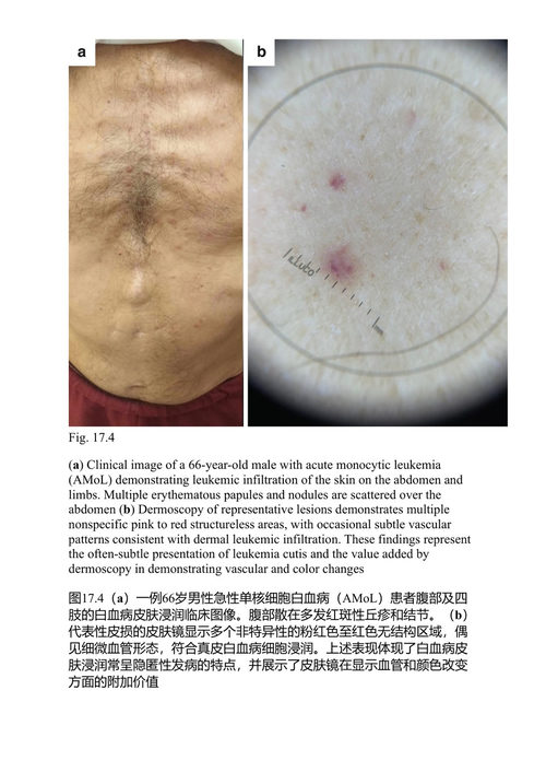 皮肤转移癌：解码癌症治疗中的皮肤病学挑战 迪米特拉·库马基 & 马里奥斯·帕帕达基斯 & 斯塔马蒂奥斯·格雷戈里乌 (中英对照电子书)