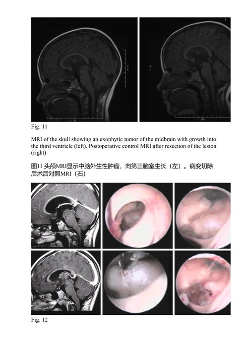 神经外科的进展与技术标准（第56卷） 康西齐奥·迪·罗科 主编 (中英对照电子书)