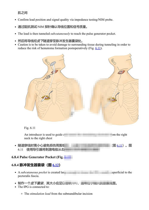 睡眠外科要点 吴泽光与杜松达主编 (中英对照电子书)